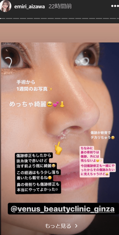 元「歌舞伎町イチの嬢王」愛沢えみり、“鼻の骨削り整形”写真を公開「本当にやってよかった」の画像